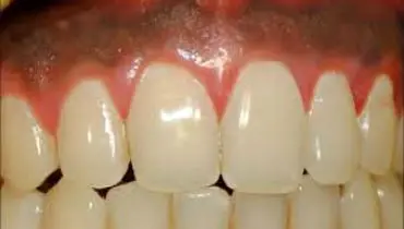 سیاه شدن لثه بعد از ایمپلنت: علل، پیشگیری و درمان
