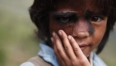 دختر غول‌نمای نپالی جراحی شد +عکس