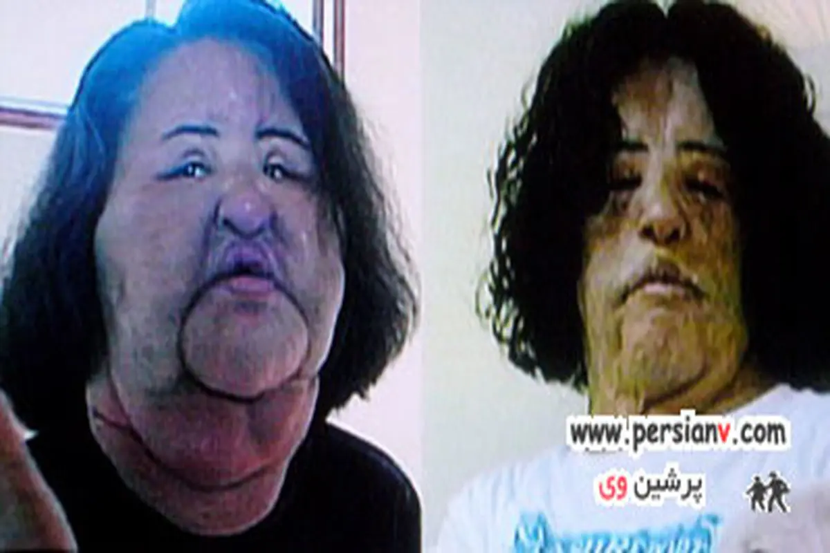 زنی که روغن خوراک پزی به صورتش تزریق کرد +عکس قبل و بعد