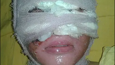 دختر جوان قربانی اسید پاشی پدرش+ عکس