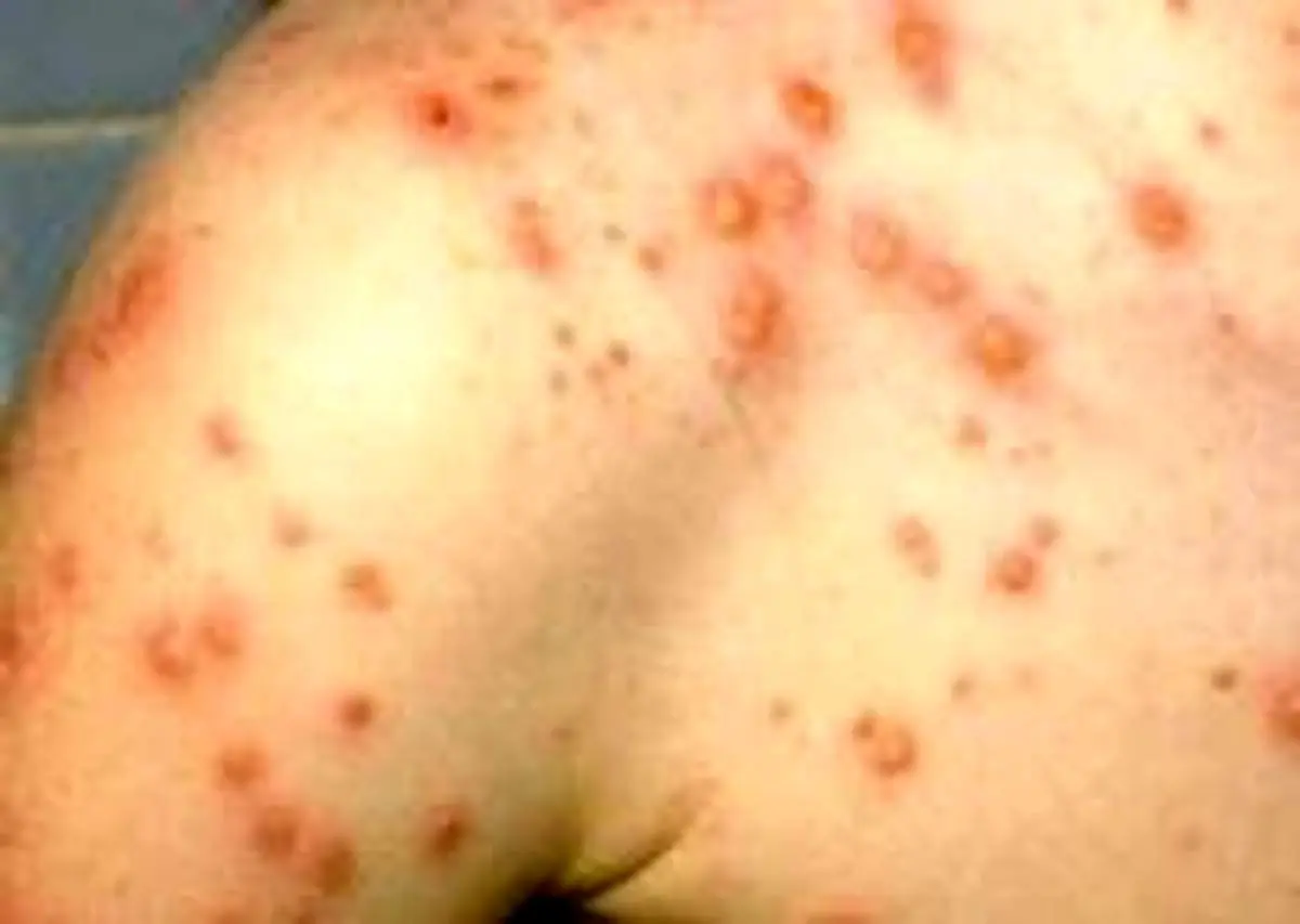 وقتی پوست ناگهان تاول می زند