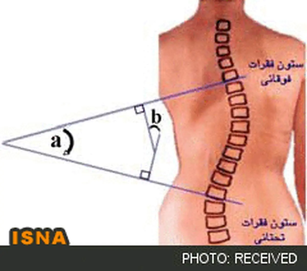 آیا اسکولیوز درمان می‌شود؟
