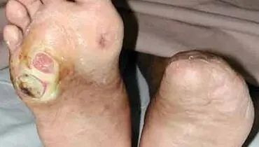 20 ماده غذایی دشمن دیابت