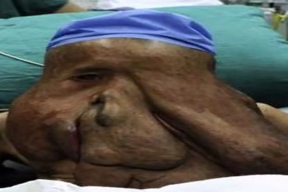 جراحی مردی با تومور 15 کیلویی در صورت