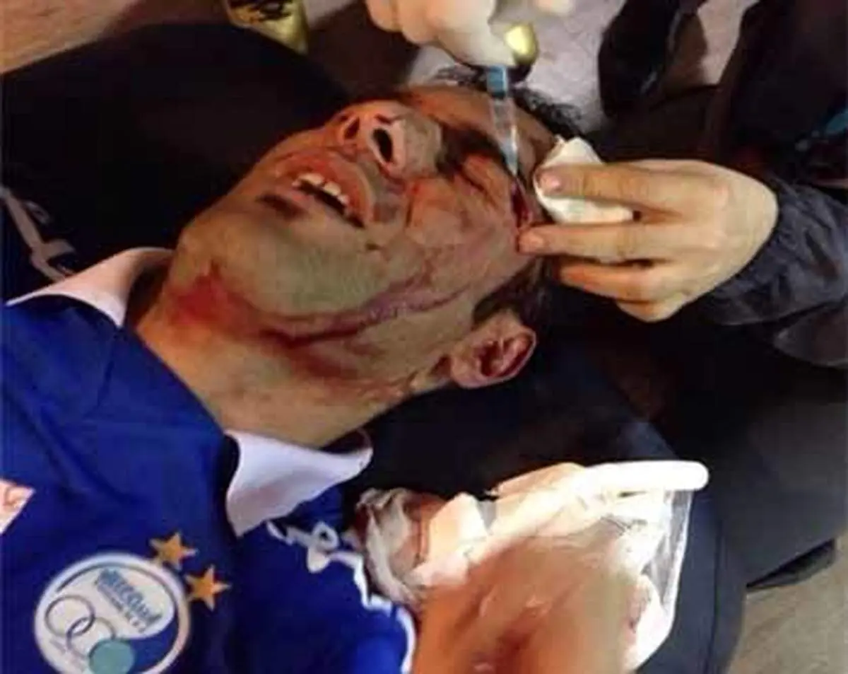 عکس/ ابروی پاره‌شده حنیف عمران‌زاده