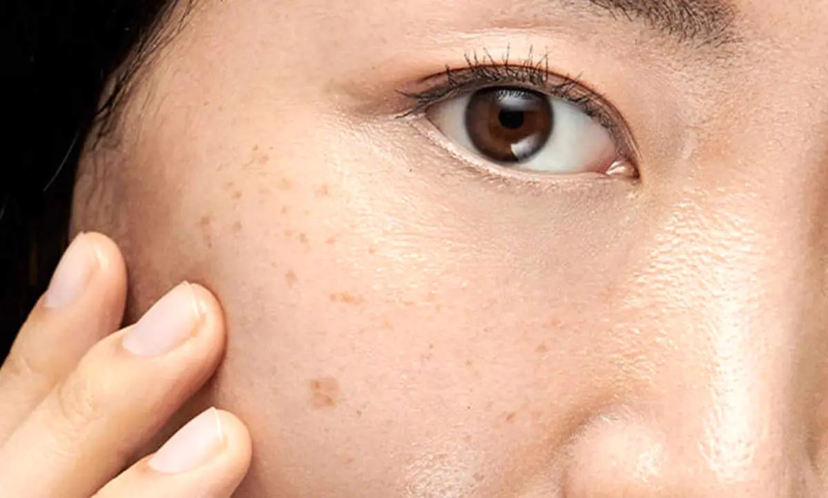 راههای برای کاهش و از بین بردن لک های صورت 
