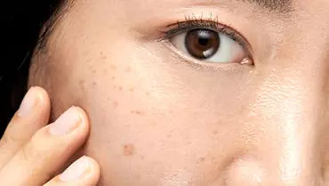 راههای برای کاهش و از بین بردن لک های صورت 
