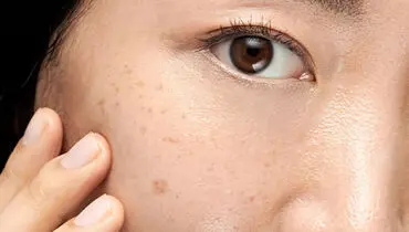 راههای برای کاهش و از بین بردن لک های صورت 
