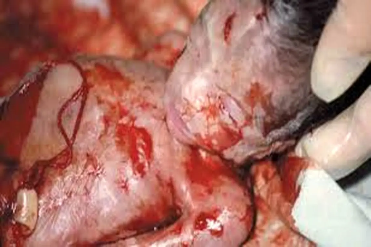 مرگ ٩٧٣ جنین در تهران پیش از تولد