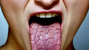نسخه خوراکی برای از بین بردن خشکی دهان