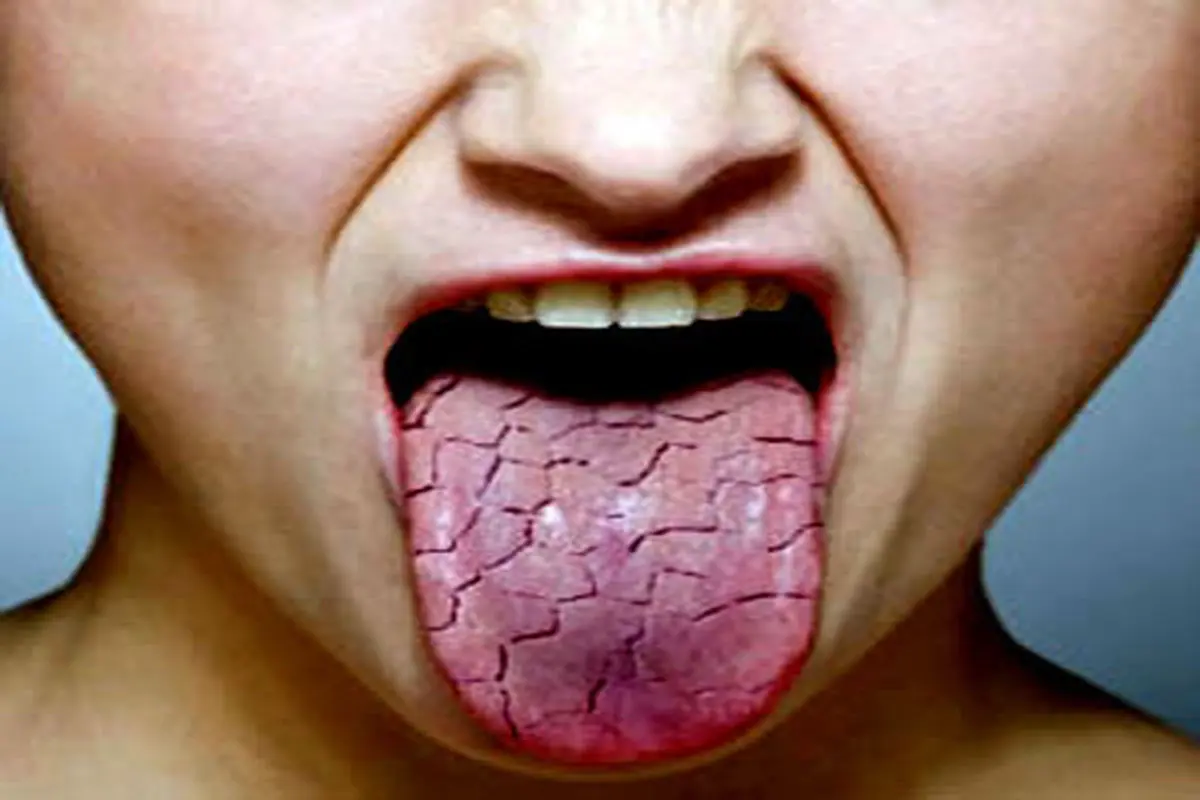 نسخه خوراکی برای از بین بردن خشکی دهان