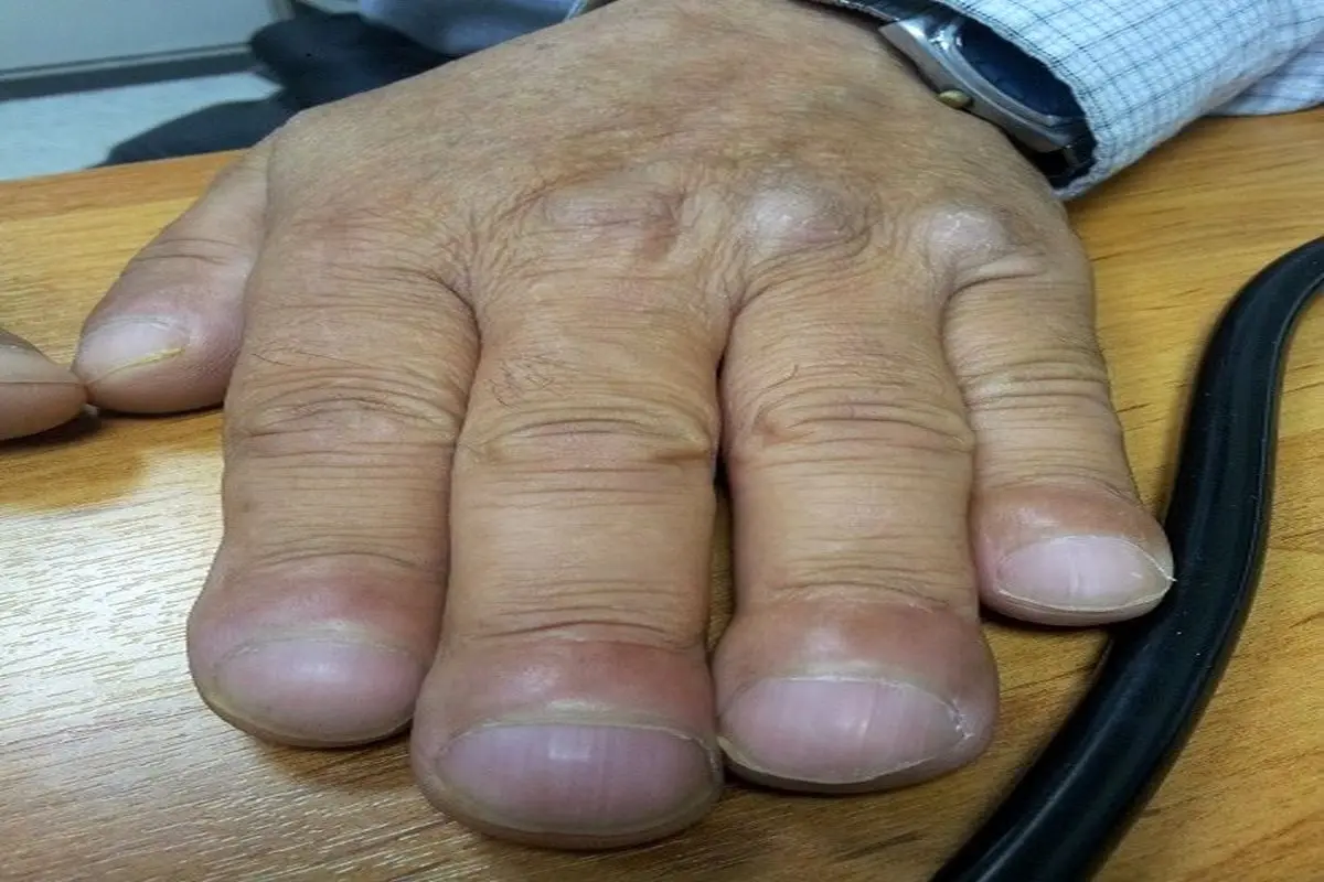 انگشتان یک بیمار مبتلا به سرطان ریه