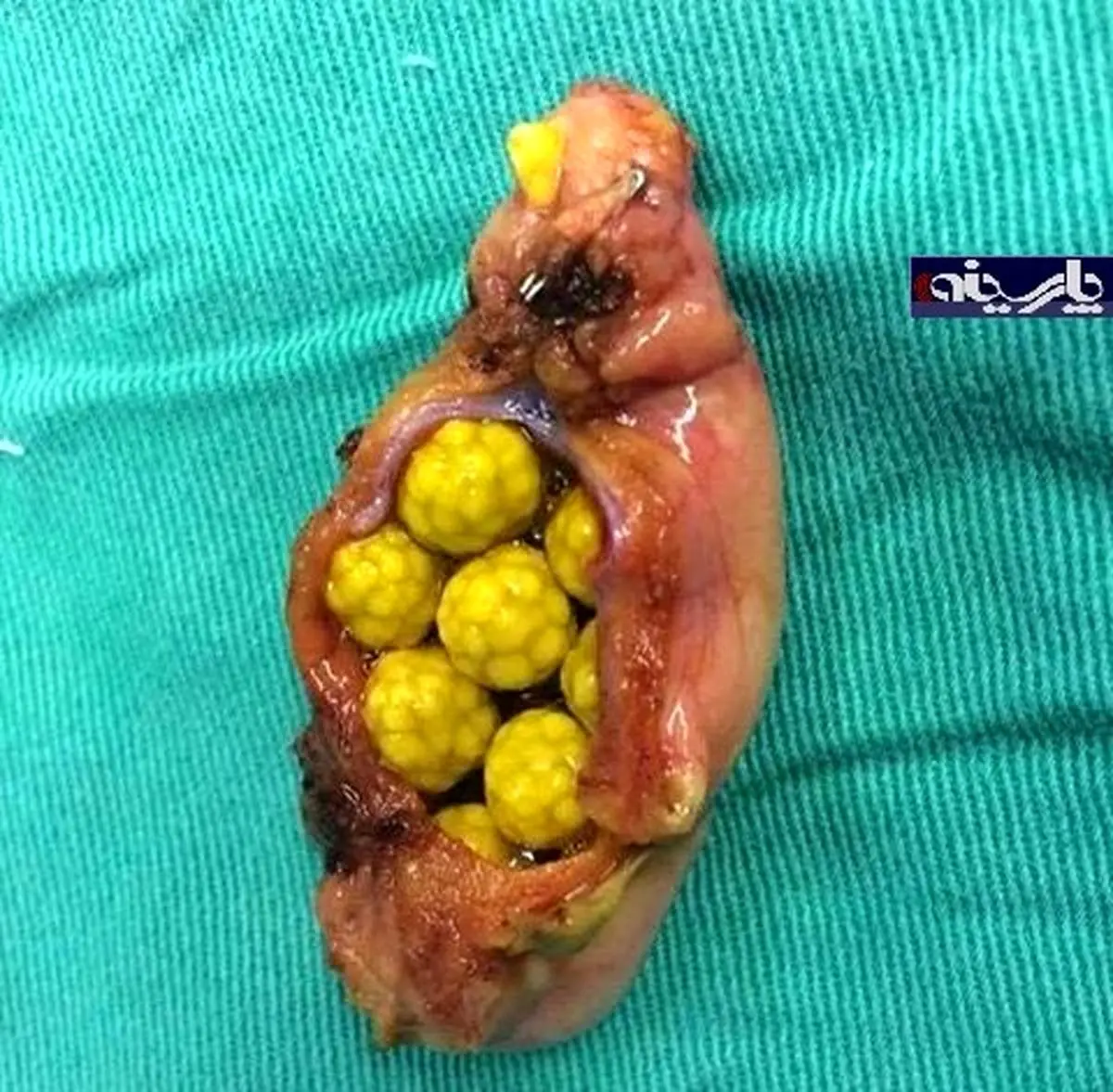 عکس/سنگ کیسه صفرا