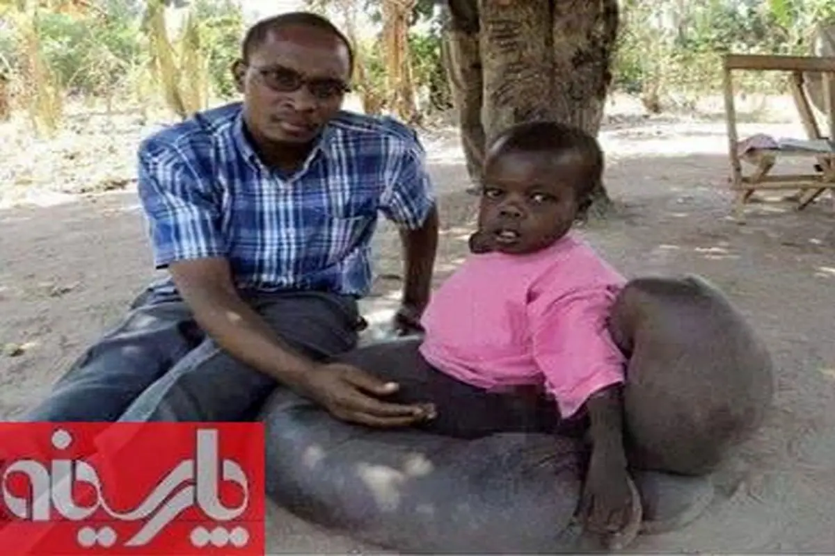 عکس:بیماری نادر یک کودک آفریقایی