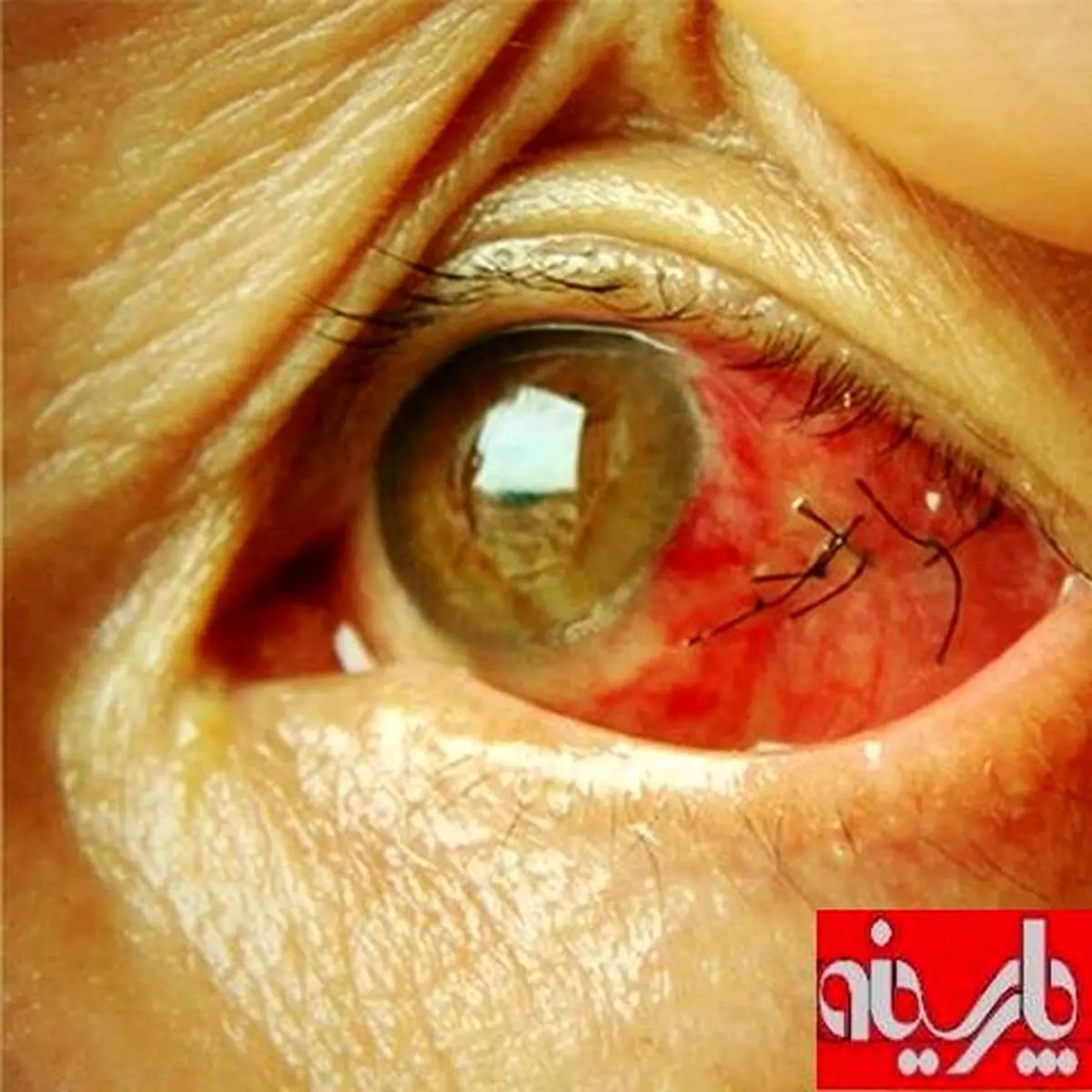 عکس:بخیه چشم