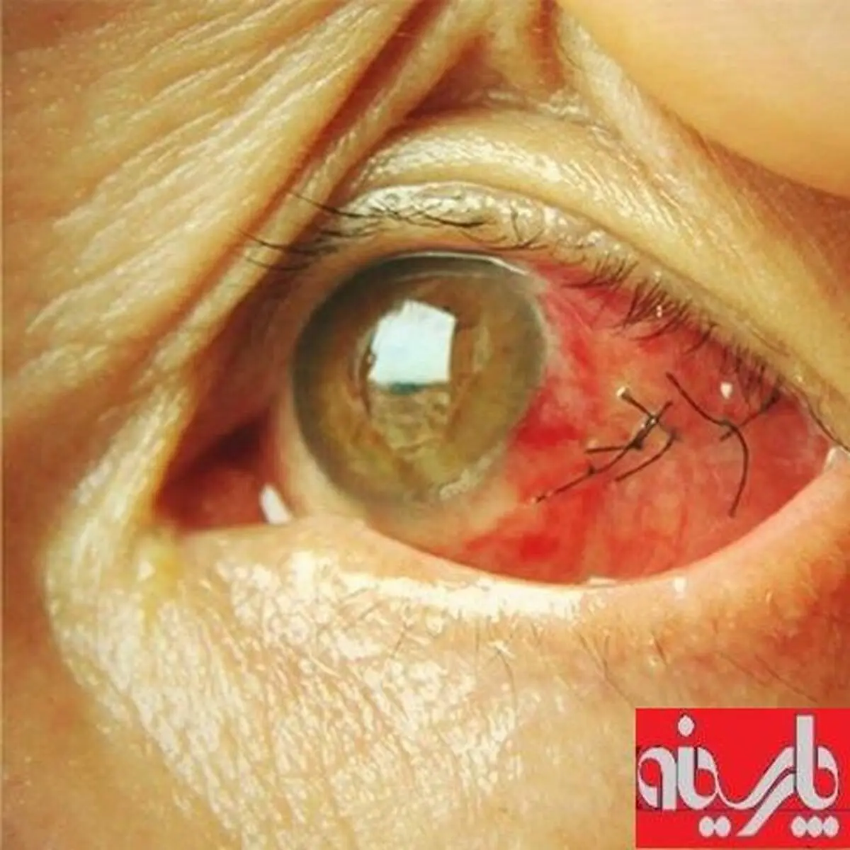 عکس:بخیه چشم