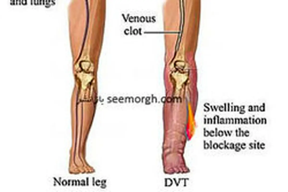 درمان لخته خون پا با ۹ روش خانگی