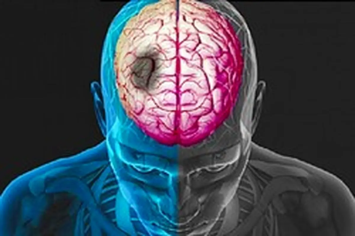 چرا سن سکته مغزی پایین آمده است؟