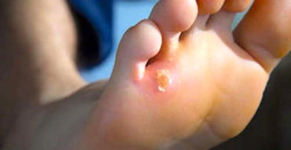 درمان میخچه در منزل با ۷ روش ساده