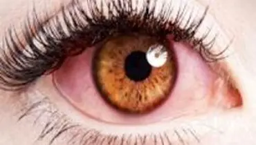 این علائم در چشم ها نشانه چیست؟
