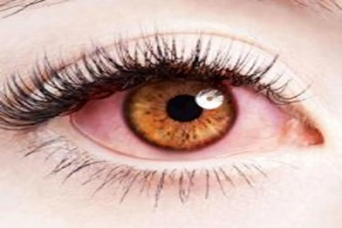 این علائم در چشم ها نشانه چیست؟
