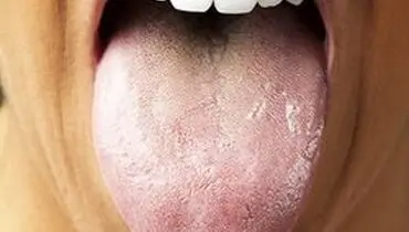 تشخیص سرطان پانکراس با بررسی باکتری زبان!