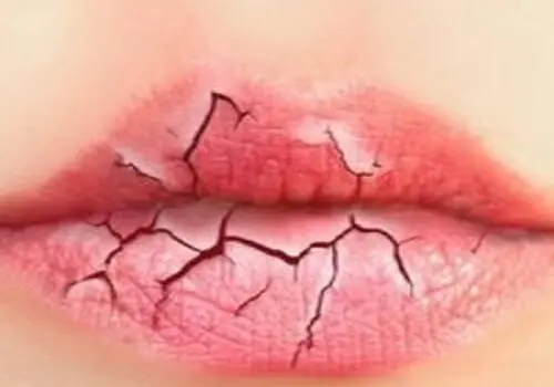 چگونه ترک لب را درمان کنیم؟