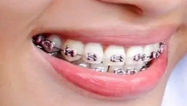 درباره ارتودنسی همه چیز را بدانید