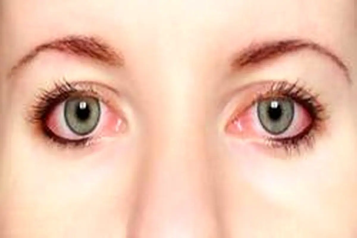 التهاب چشم چیست و چرا بوجود می‌آید