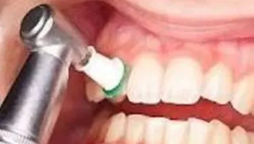 باید و نبایدهای جرم گیری دندان
