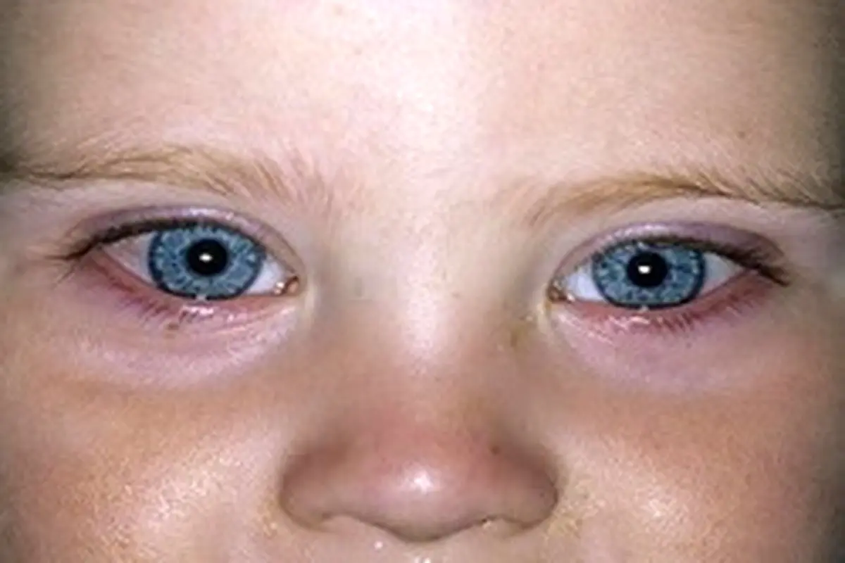 آشنایی با علایم مشکلات بینایی نوزادان