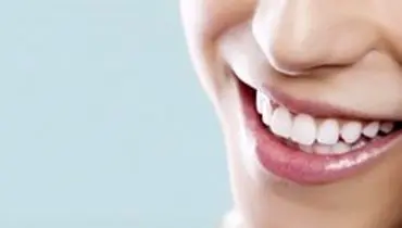 سوالات رایج در مورد سفید کردن دندان ها به صورت طبیعی