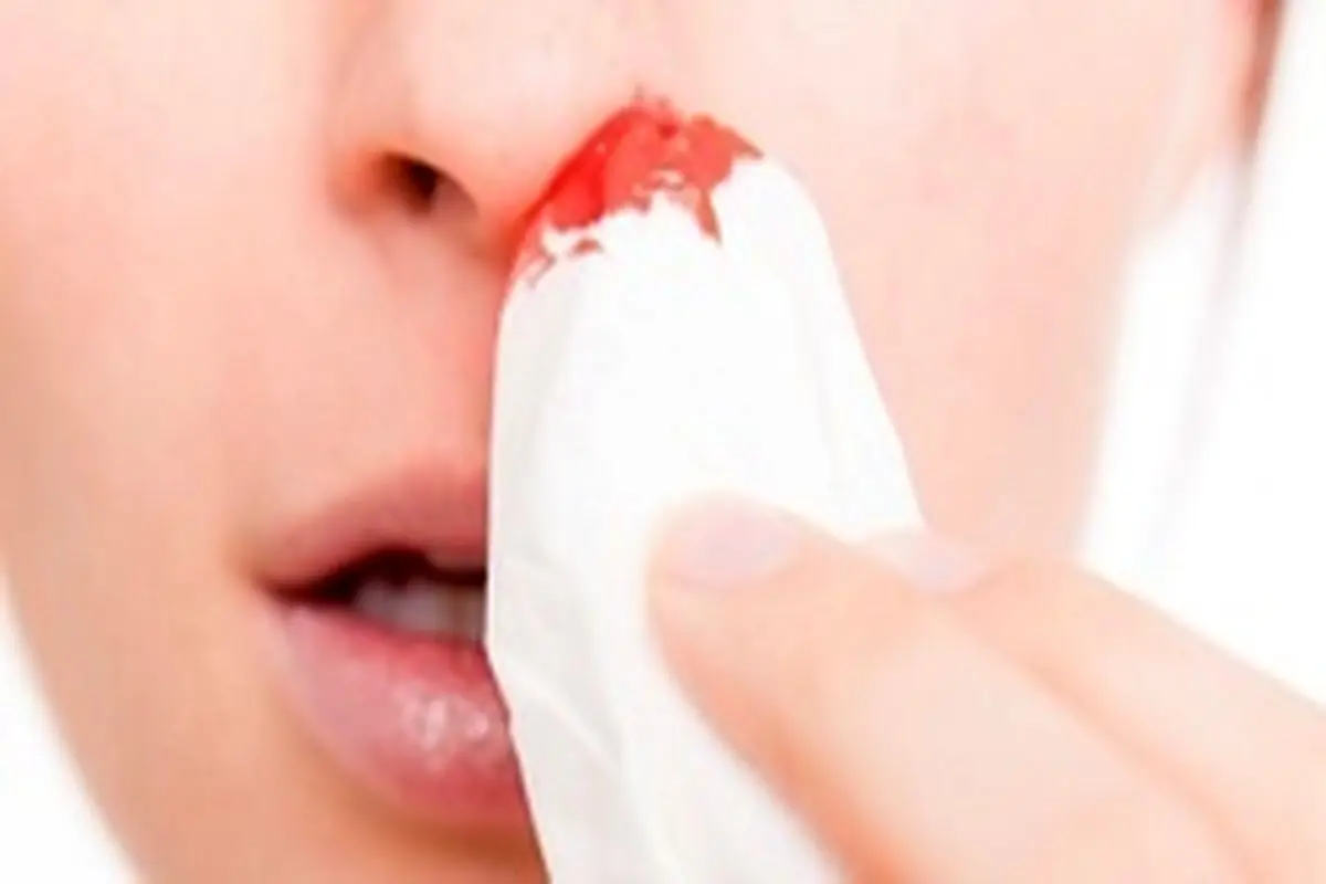 علت خونریزی از بینی چیست؟