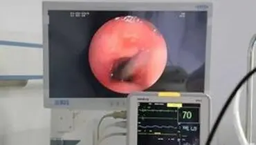 خارج کردن زالوی ۱۰ سانتی از گلوی مرد چینی! +عکس