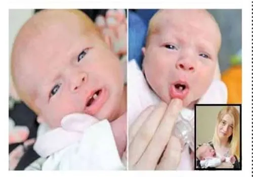 تولد یک نوزاد با دندان + عکس