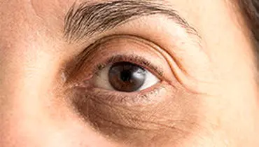 علت‌ها و روش‌های درمان سیاهی دور چشم