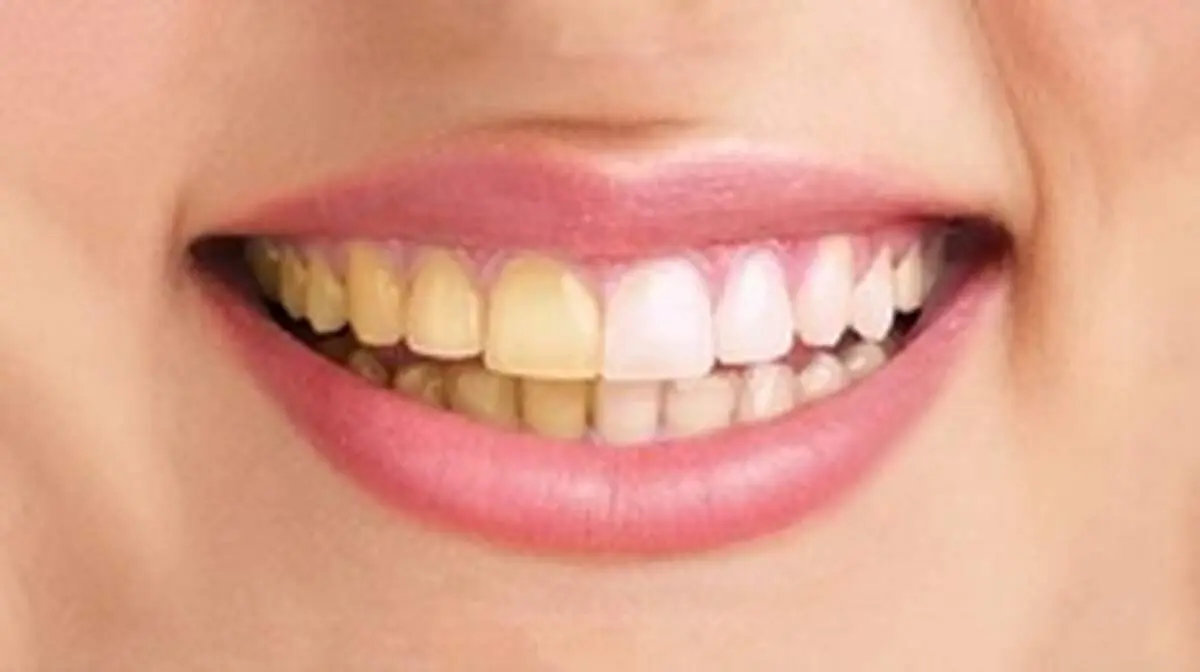 چرا رنگ دندانم تغییر کرد؟