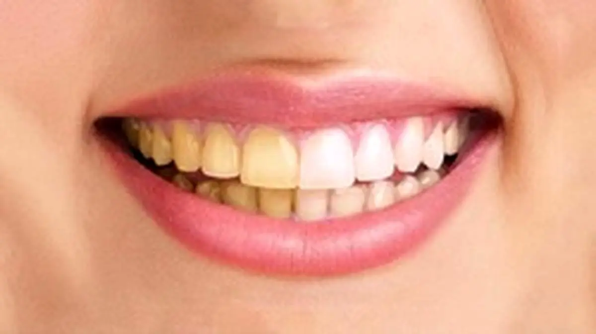 چرا رنگ دندانم تغییر کرد؟