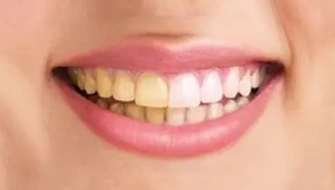 چرا رنگ دندانم تغییر کرد؟
