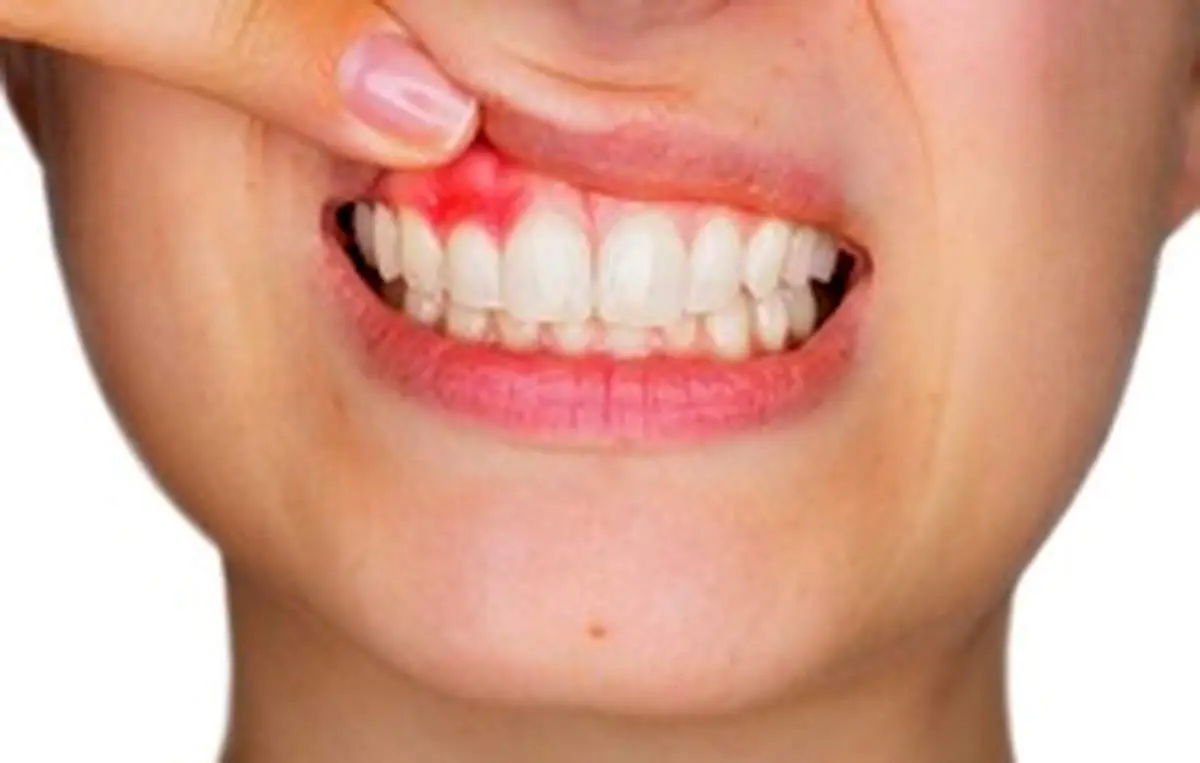 تیرگی لثه‌ها نشانه چیست؟