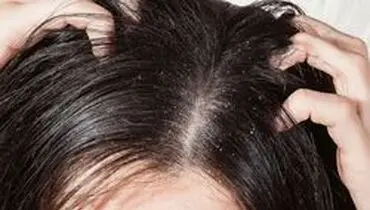 بهترین راه‌های طبیعی درمان شوره سر کدامند؟