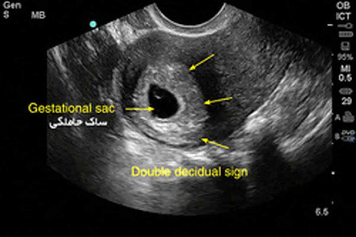 ساک حاملگی چیست و مشاهده یا عدم مشاهده آن چه معنایی دارد؟