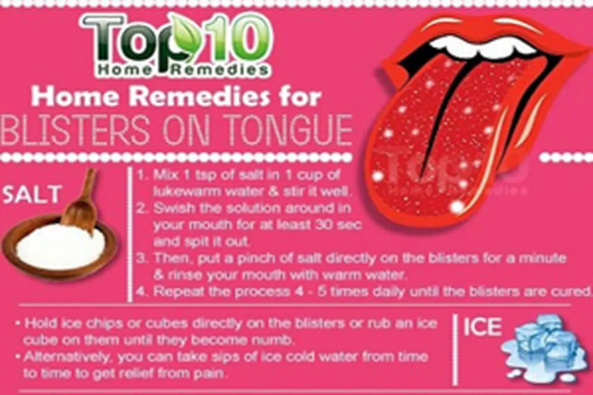 ۱۰ راه حل برای درمان تاول روی زبان