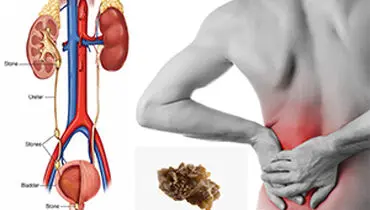 برای دفع سنگ کلیه چه کنیم؟