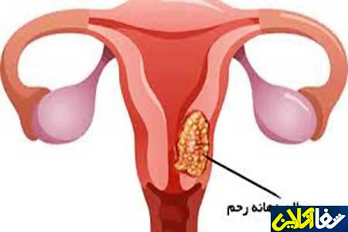 نشانههای ابتلا به زخم دهانه رحم