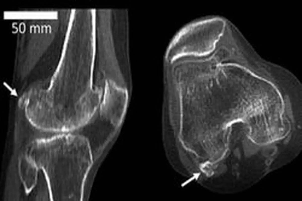 استخوان منسوخ شده در بدن انسان ظاهر شد! +عکس