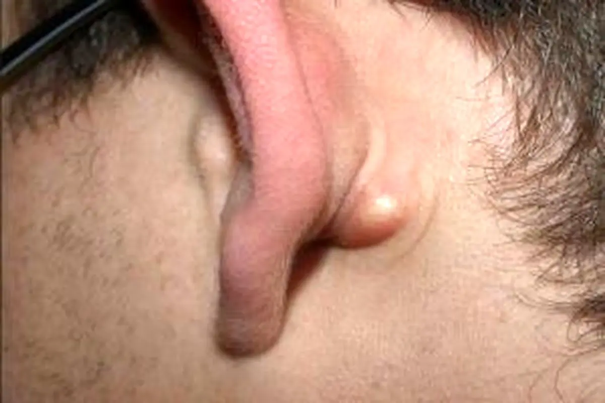 چرا برآمدگى پشت گوش بوجود می‌آید و درمان آن چیست؟