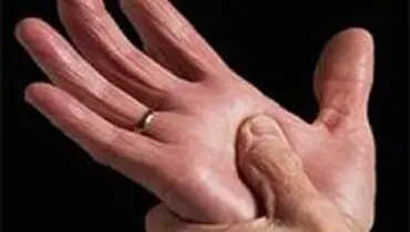 درمان آرتروز با سلول‌های بنیادی