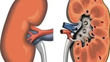 کیست‌های کلیه چگونه شناسایی می‌شوند؟