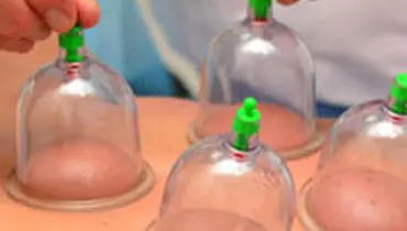 زمان انجام حجامت و فواید حجامت